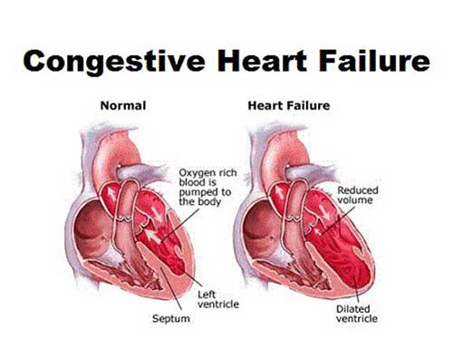 Congestive Heart Failure - Dr. VT Shah